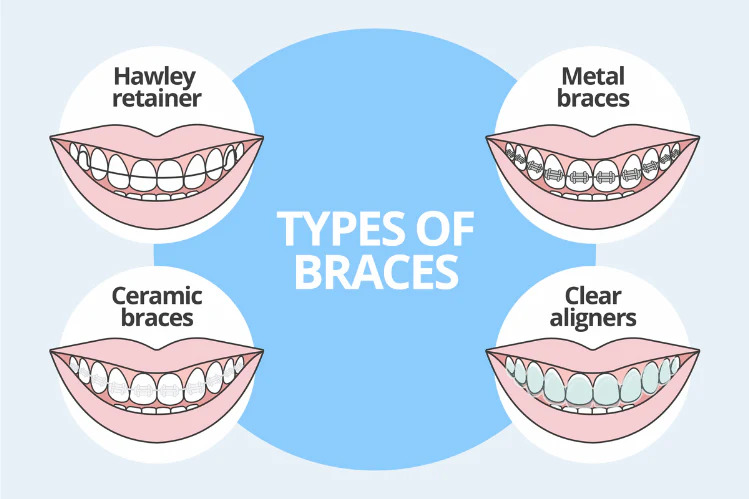 different types of dental braces